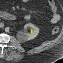 Kidney / Ureter Stones bounding-box exemplar 9
