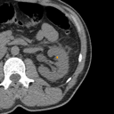 Kidney / Ureter Stones bounding-box exemplar 1