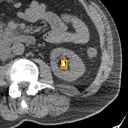 Kidney / Ureter Stones bounding-box exemplar 12