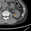 Kidney / Ureter Stones bounding-box exemplar 6