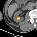 Kidney / Ureter Stones bounding-box exemplar 14
