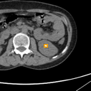 Kidney / Ureter Stones bounding-box exemplar 7