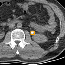 Kidney / Ureter Stones bounding-box exemplar 11