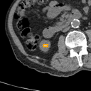 Kidney / Ureter Stones bounding-box exemplar 8