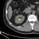 Kidney / Ureter Stones bounding-box exemplar 10