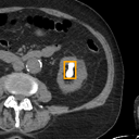 Kidney / Ureter Stones bounding-box exemplar 16