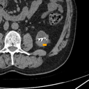 Kidney / Ureter Stones bounding-box exemplar 3