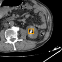 Kidney / Ureter Stones bounding-box exemplar 15