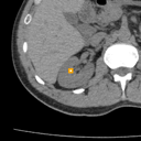Kidney / Ureter Stones bounding-box exemplar 4