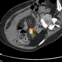 Kidney / Ureter Stones bounding-box exemplar 13
