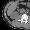 Kidney / Ureter Stones bounding-box exemplar 2
