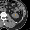 Kidney / Ureter Stones bounding-box exemplar 5