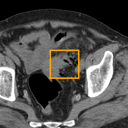Acute Diverticulitis bounding-box exemplar 14