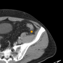 Acute Diverticulitis bounding-box exemplar 1