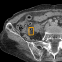 Acute Diverticulitis bounding-box exemplar 3