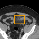Acute Diverticulitis bounding-box exemplar 15