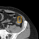 Acute Diverticulitis bounding-box exemplar 5