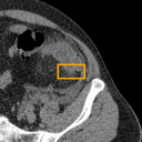 Acute Diverticulitis bounding-box exemplar 7
