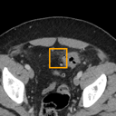 Acute Diverticulitis bounding-box exemplar 10