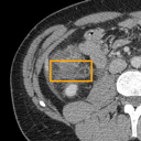 Acute Diverticulitis bounding-box exemplar 13