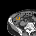 Acute Diverticulitis bounding-box exemplar 2