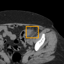 Acute Diverticulitis bounding-box exemplar 12