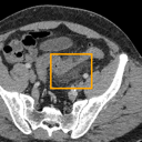 Acute Diverticulitis bounding-box exemplar 16