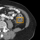 Acute Diverticulitis bounding-box exemplar 8