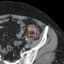 Acute Diverticulitis bounding-box exemplar 4