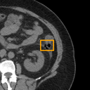 Acute Diverticulitis bounding-box exemplar 6