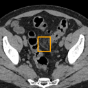 Acute Diverticulitis bounding-box exemplar 9