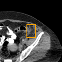 Acute Diverticulitis bounding-box exemplar 11