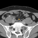 Acute Appendicitis bounding-box exemplar 1