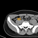Acute Appendicitis bounding-box exemplar 4
