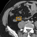 Acute Appendicitis bounding-box exemplar 14
