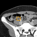 Acute Appendicitis bounding-box exemplar 13