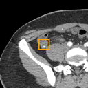 Acute Appendicitis bounding-box exemplar 15