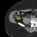 Acute Appendicitis bounding-box exemplar 5