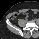 Acute Appendicitis bounding-box exemplar 3