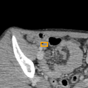 Acute Appendicitis bounding-box exemplar 6