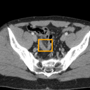Acute Appendicitis bounding-box exemplar 16