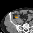 Acute Appendicitis bounding-box exemplar 8