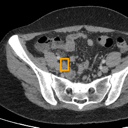 Acute Appendicitis bounding-box exemplar 10