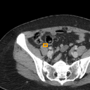 Acute Appendicitis bounding-box exemplar 2