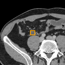 Acute Appendicitis bounding-box exemplar 9