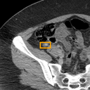 Acute Appendicitis bounding-box exemplar 12
