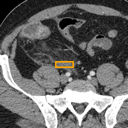 Acute Appendicitis bounding-box exemplar 11