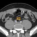 Acute Appendicitis bounding-box exemplar 7
